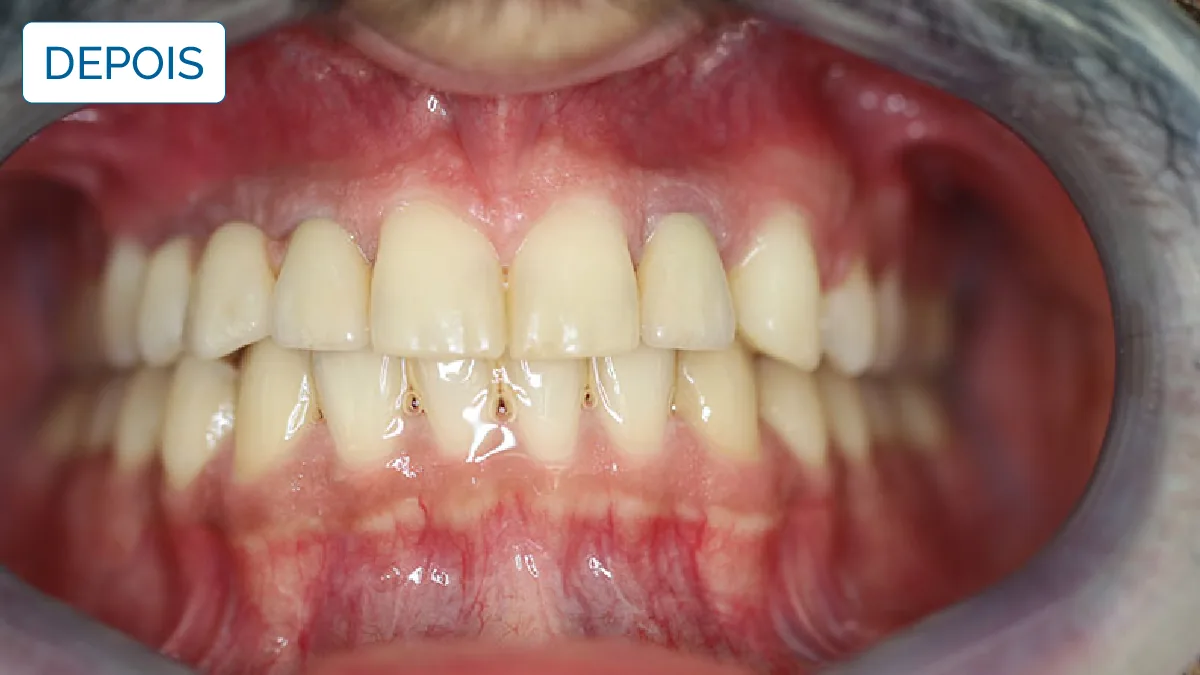 Implantologia — LusoClinic (3)