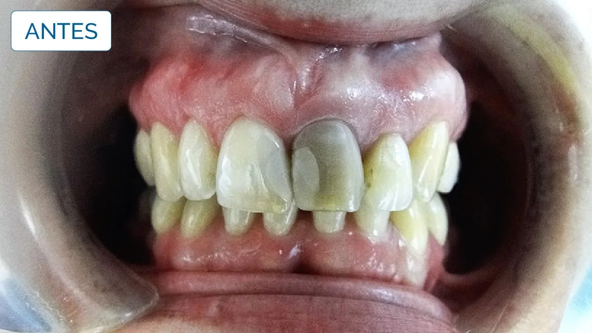 Implantologia — LusoClinic (5)