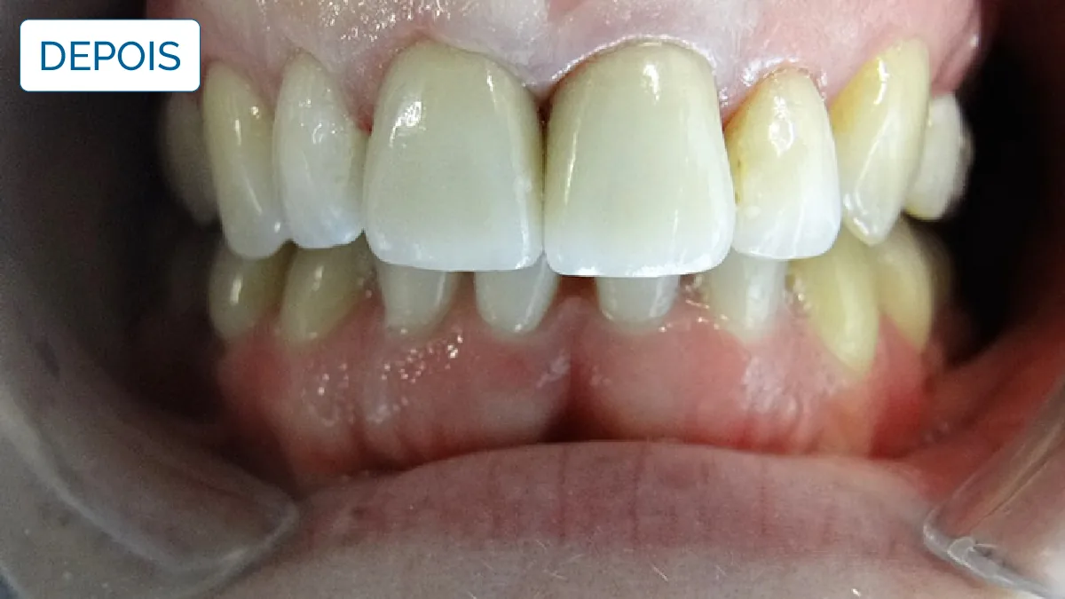Implantologia — LusoClinic (6)