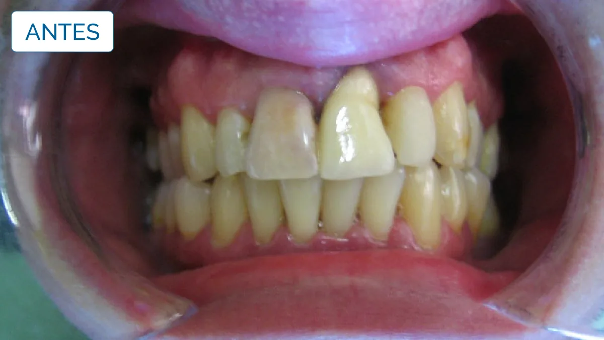 Implantologia — LusoClinic (7)
