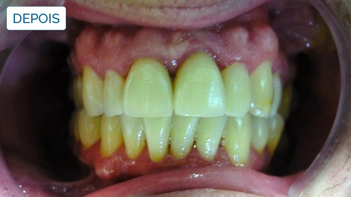 Implantologia — LusoClinic (8)