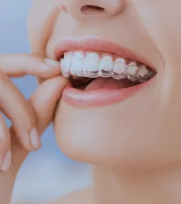Aparelhos invisalign