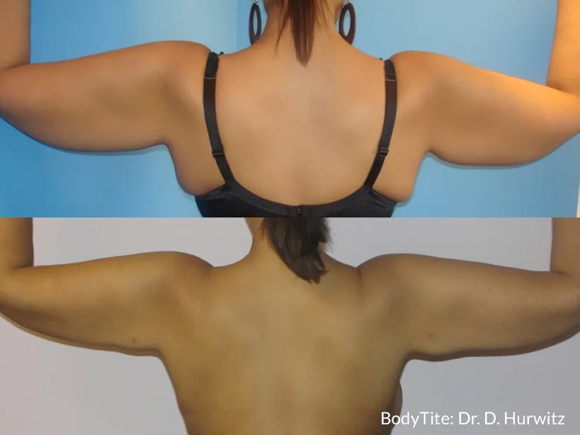 Lipoaspiração sem cirurgia/Bodytite — LusoClinic (5)