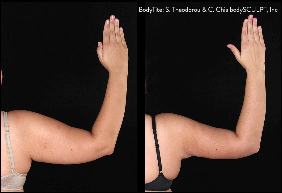 Lipoaspiração sem cirurgia/Bodytite — LusoClinic (2)
