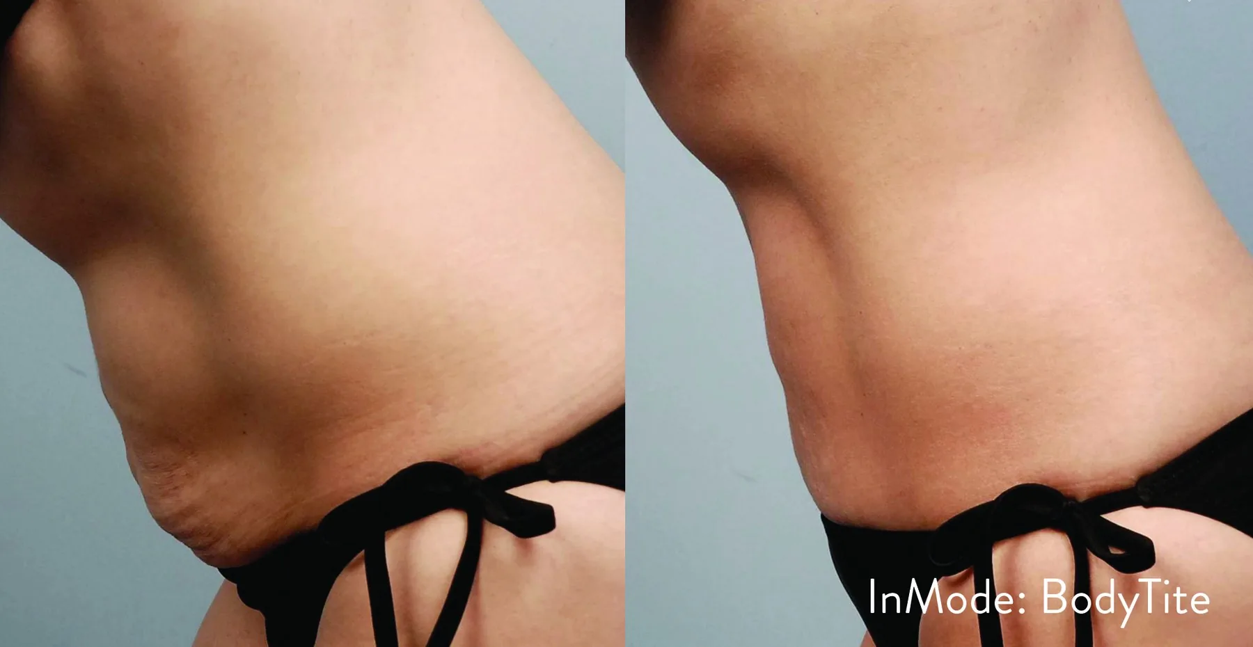 Lipoaspiração sem cirurgia/Bodytite — LusoClinic (4)
