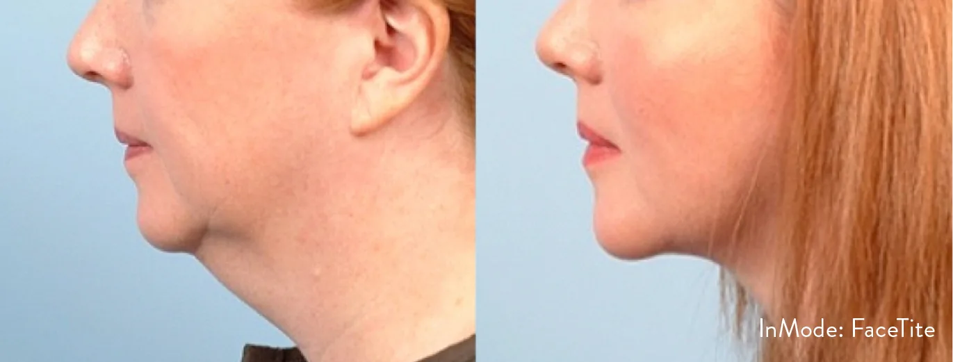 Lipoaspiração sem cirurgia/Bodytite — LusoClinic (3)