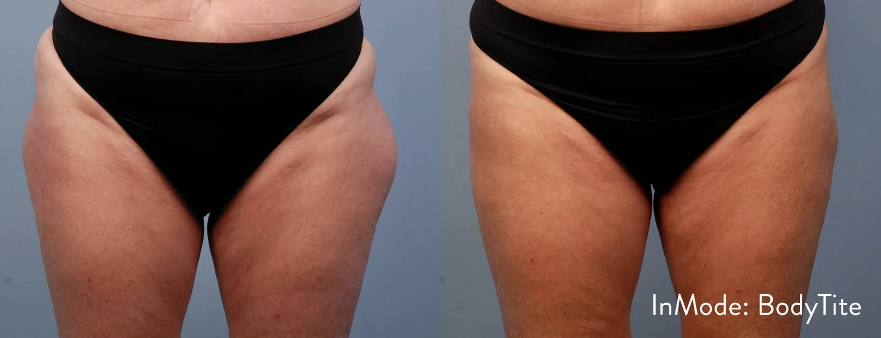 Lipoaspiração sem cirurgia/Bodytite — LusoClinic (7)