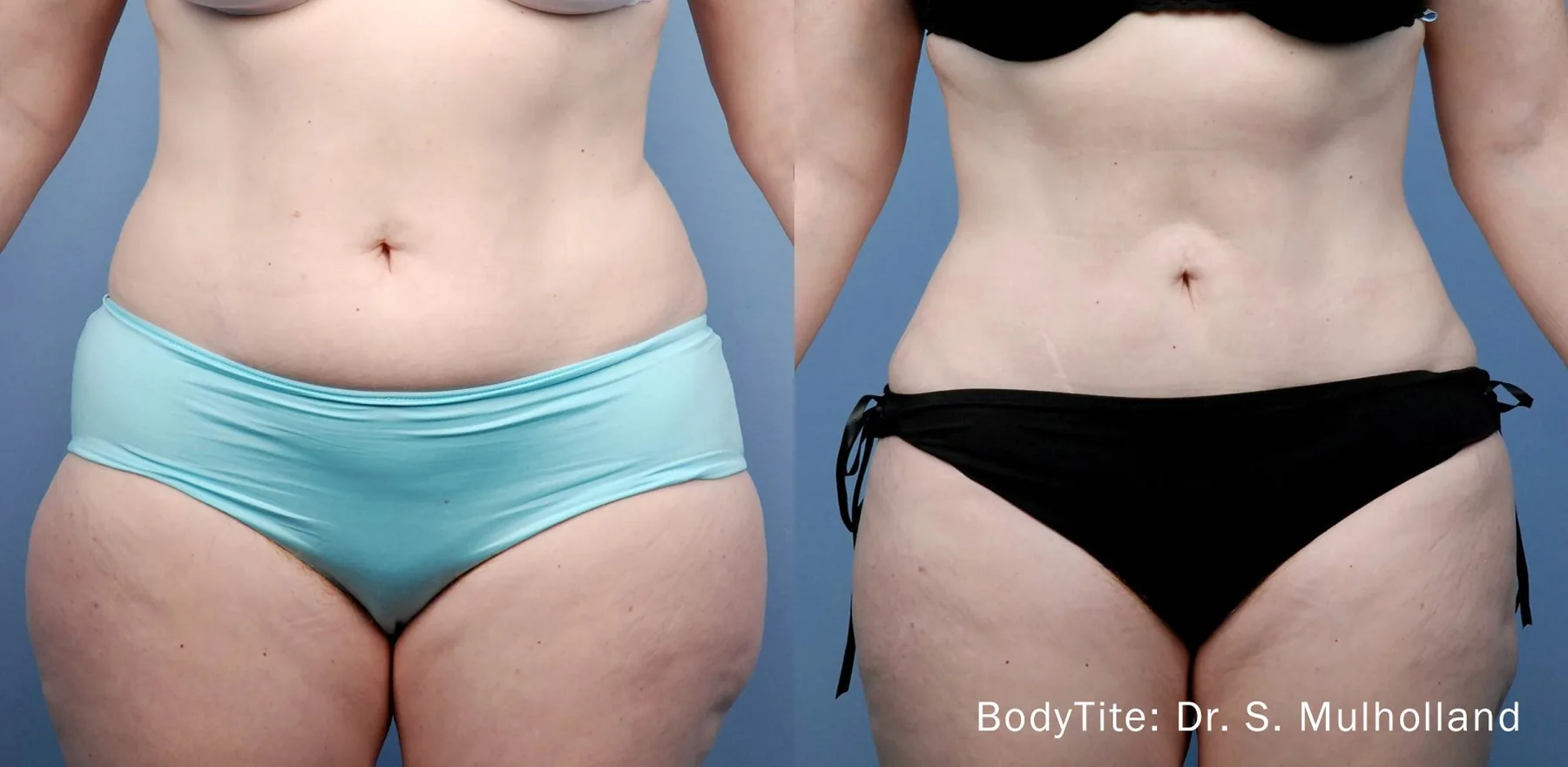 Lipoaspiração sem cirurgia/Bodytite — LusoClinic